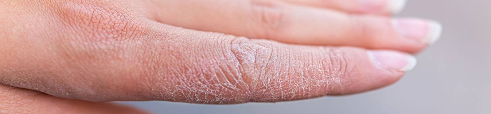 Homeopathy-skin-Atopic Dermatitis