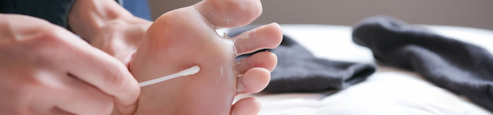 Homeopathy-skin-Tinea