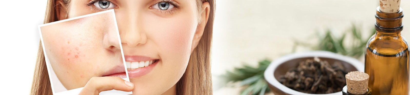 Homeopathy-skin-Acne