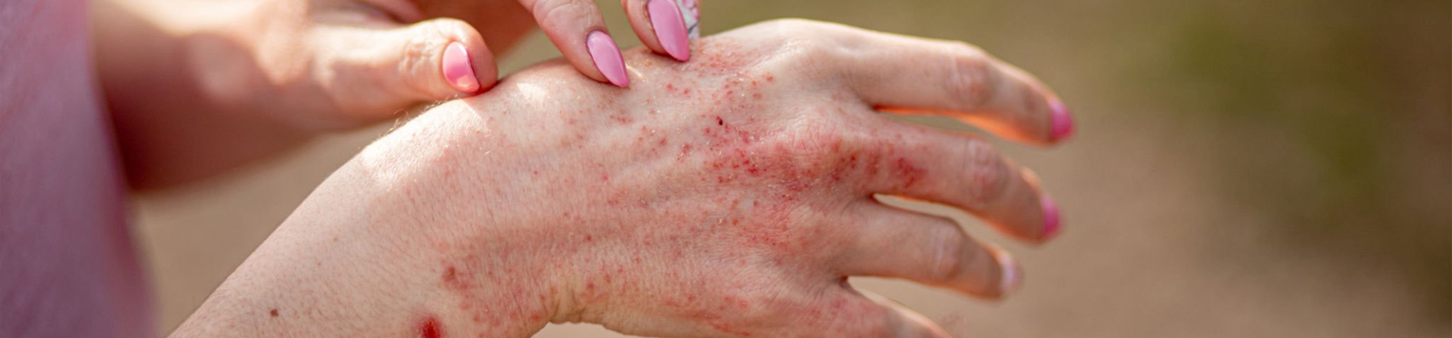 Homeopathy-skin-psoriasis