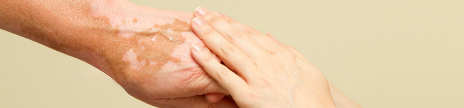 Homeopathy-skin-Vitiligo